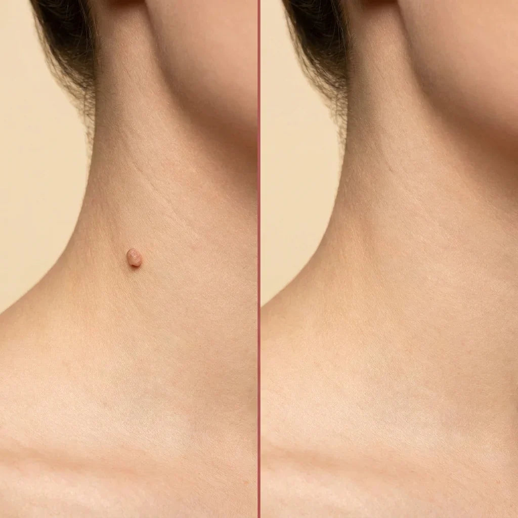 ClearTag Microneedle Skin Tag Patches