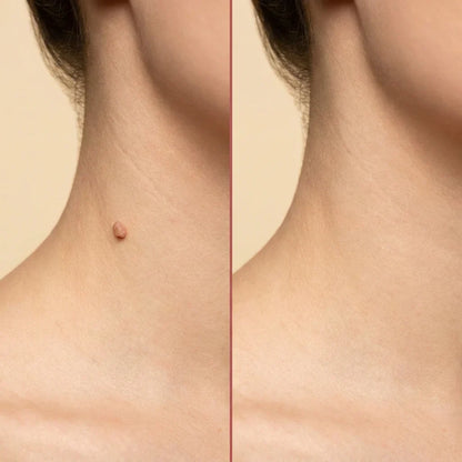ClearTag Microneedle Skin Tag Patch